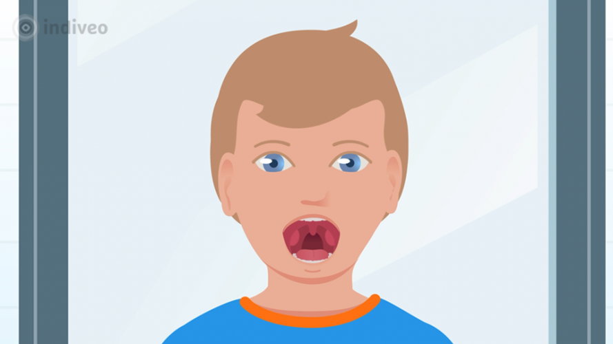 Verwijderen van amandelen (kinderen) Indiveo