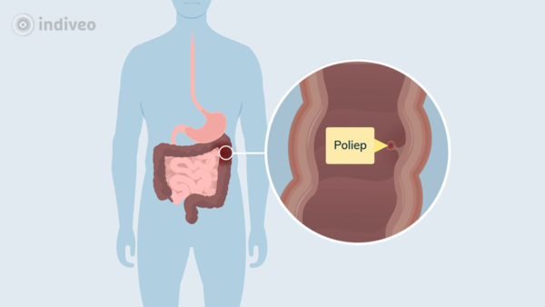 Poliepen In De Dikke Darm Indiveo