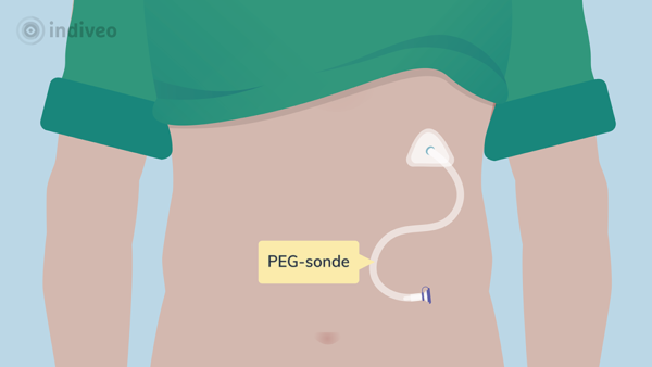 Plaatsing van een PEG- of PEG J-sonde - Indiveo