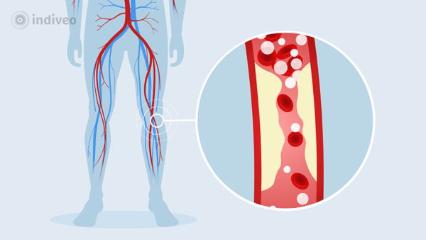 Perifeer Arterieel Vaatlijden (PAV) - Indiveo