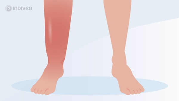 Behandelmogelijkheden bij diep veneuze trombose - Indiveo