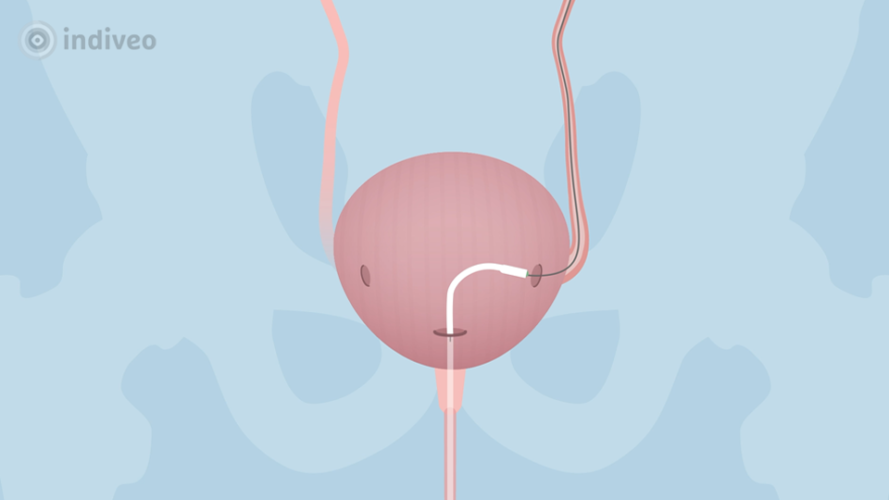 Dubbel J-katheter - Indiveo