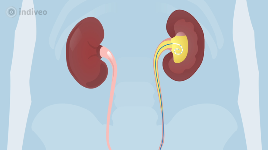 Dubbel Jkatheter Indiveo